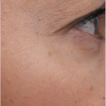 Redness & Rosacea Before & After Patient #18149