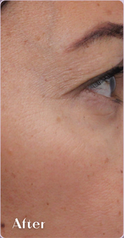 Redness & Rosacea Before & After Patient #18149