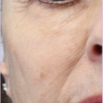 Redness & Rosacea Before & After Patient #18148