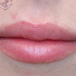 Lip Augmentation Before & After Patient #18194