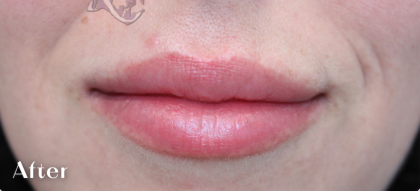 Lip Augmentation Before & After Patient #18194