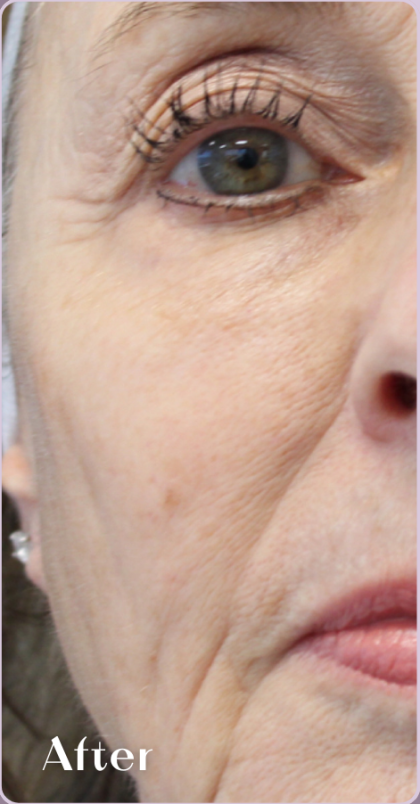 Redness & Rosacea Before & After Patient #18148