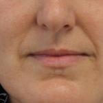 Facial Rejuvenation Before & After Patient #18104