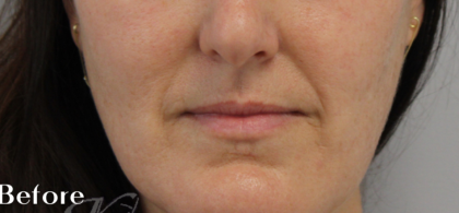 Facial Rejuvenation Before & After Patient #18104