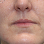 Facial Rejuvenation Before & After Patient #18104