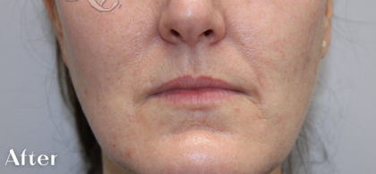 Facial Rejuvenation Before & After Patient #18104