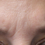 Lines & Wrinkles Before & After Patient #18113