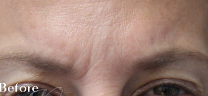 Lines & Wrinkles Before & After Patient #18113