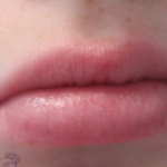 Lip Augmentation Before & After Patient #18195