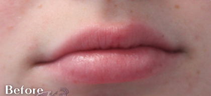 Lip Augmentation Before & After Patient #18195