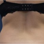 Body Contouring Before & After Patient #18099