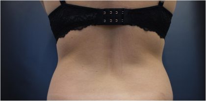 Body Contouring Before & After Patient #18099