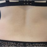 Body Contouring Before & After Patient #18099