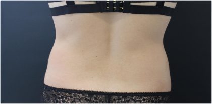 Body Contouring Before & After Patient #18099