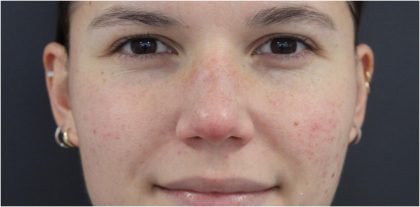 Redness & Rosacea Before & After Patient #18150