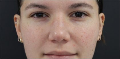 Redness & Rosacea Before & After Patient #18150