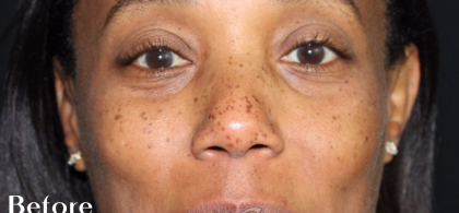 Skin Tone & Texture Before & After Patient #18163