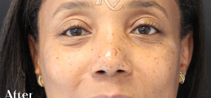 Skin Tone & Texture Before & After Patient #18163