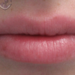 Lip Augmentation Before & After Patient #18195