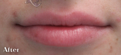 Lip Augmentation Before & After Patient #18195