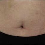 Body Contouring Before & After Patient #18100