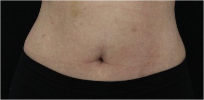 Body Contouring Before & After Patient #18100