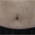 Body Contouring Before & After Patient #18100