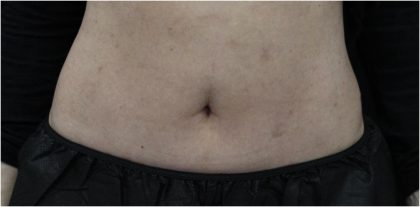 Body Contouring Before & After Patient #18100