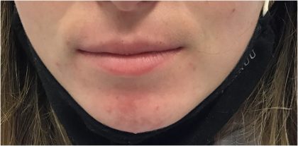 Redness & Rosacea Before & After Patient #18151