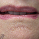 Lip Augmentation Before & After Patient #18196