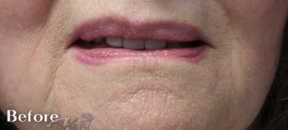 Lip Augmentation Before & After Patient #18196