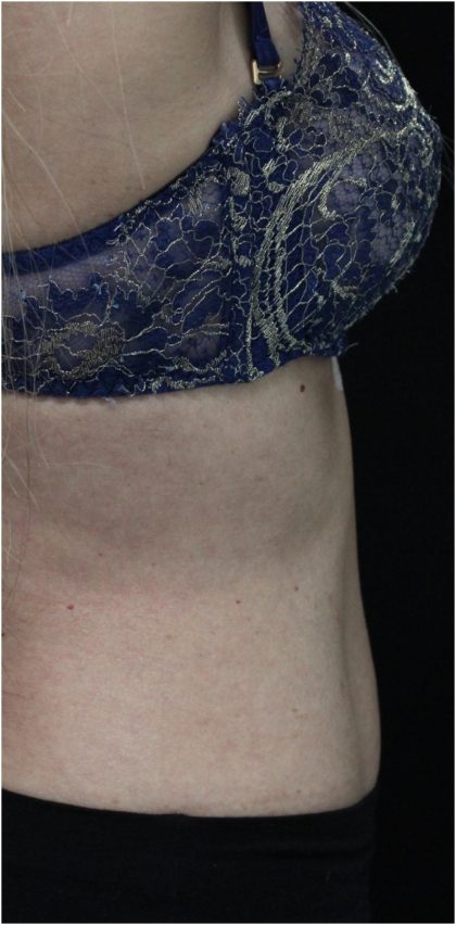 Body Contouring Before & After Patient #18101