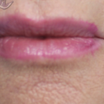 Lip Augmentation Before & After Patient #18196