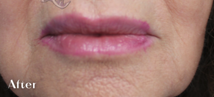 Lip Augmentation Before & After Patient #18196