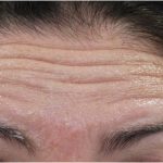 Lines & Wrinkles Before & After Patient #18115