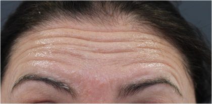 Lines & Wrinkles Before & After Patient #18115