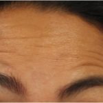 Lines & Wrinkles Before & After Patient #18116