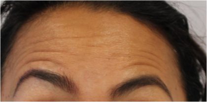 Lines & Wrinkles Before & After Patient #18116