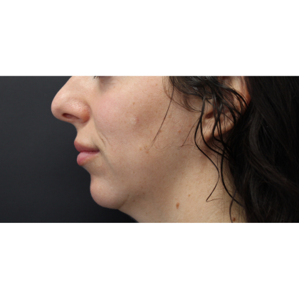 Chin Augmentation Before & After Patient #18182