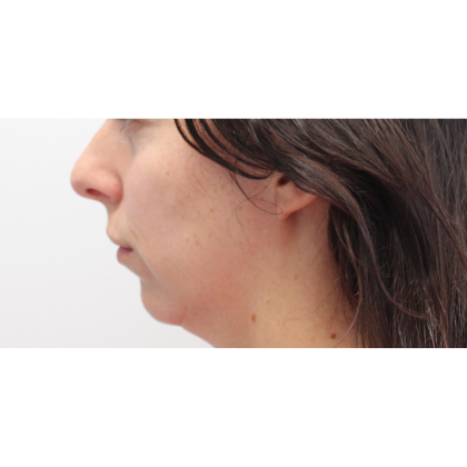 Chin Augmentation Before & After Patient #18182