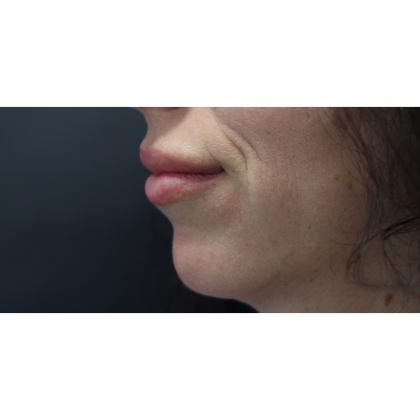 Chin Augmentation Before & After Patient #18183