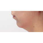 Chin Augmentation Before & After Patient #18183